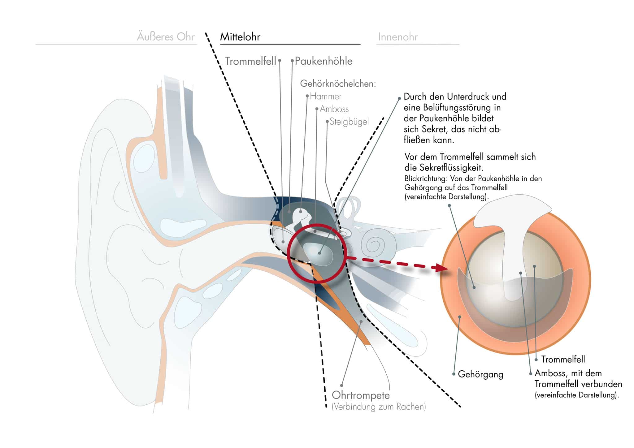 Paukenerguss Behandeln Ursache Diagnose Therapie